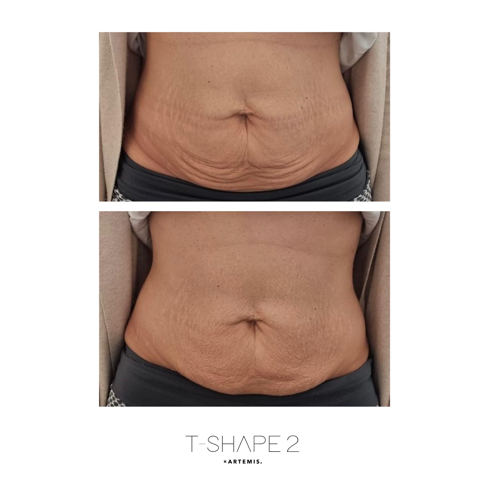 Abs result