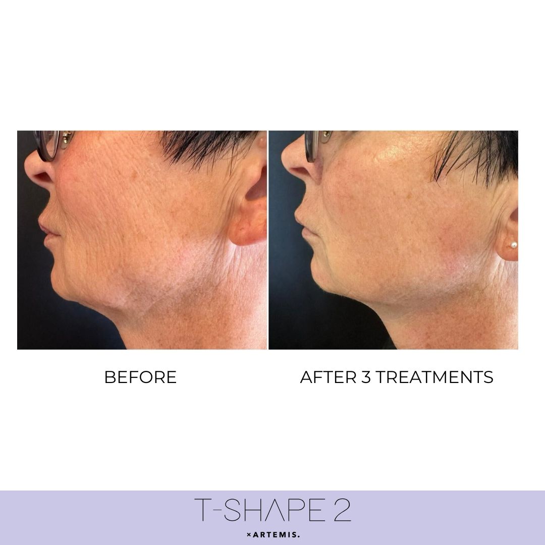 Neck result